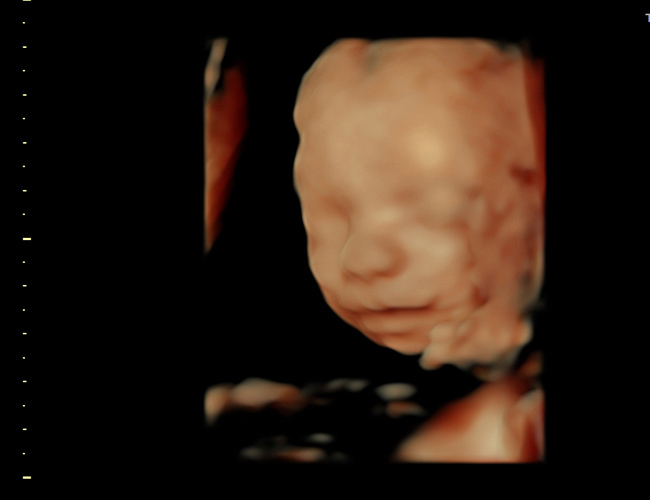 3D ultrasound image at 25 weeks